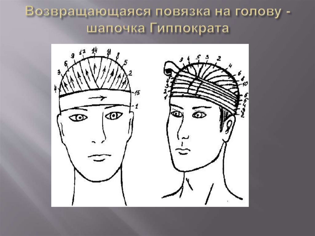 Возвращающаяся повязка на голову - шапочка Гиппократа
