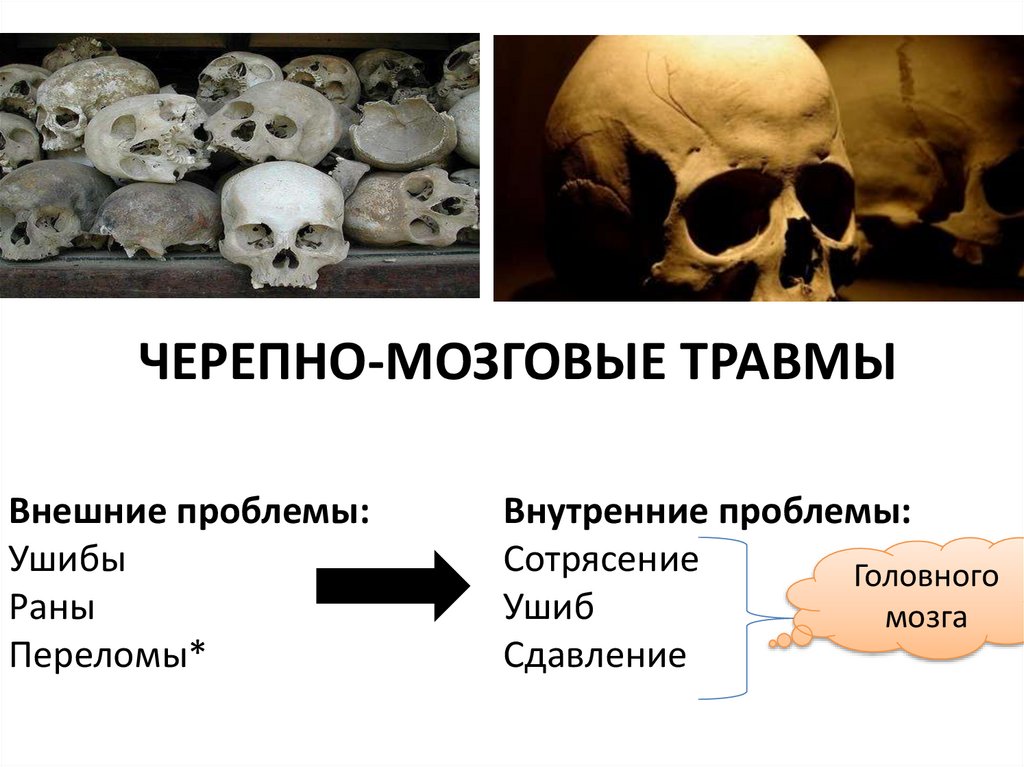 ЧЕРЕПНО-МОЗГОВЫЕ ТРАВМЫ