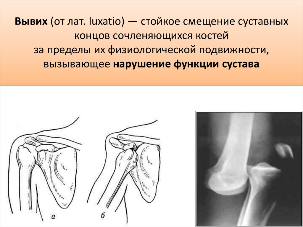 Вывих (от лат. luxatio) — стойкое смещение суставных концов сочленяющихся костей за пределы их физиологической подвижности,
