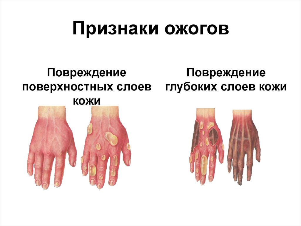 Признаки ожогов