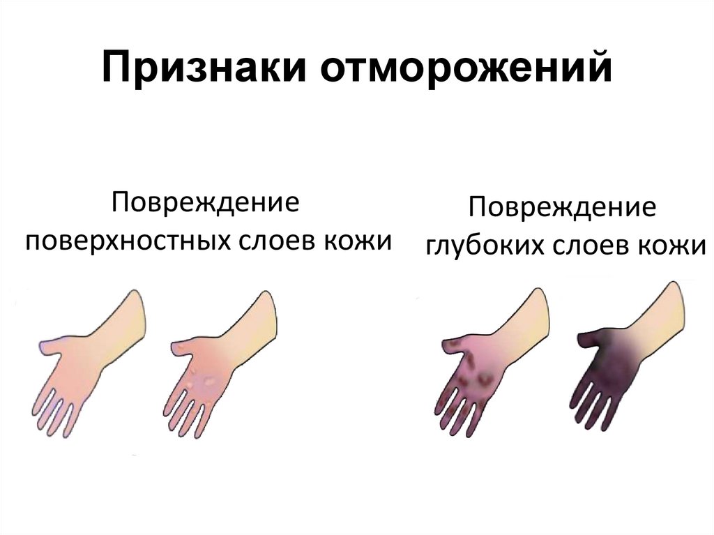 Признаки отморожений