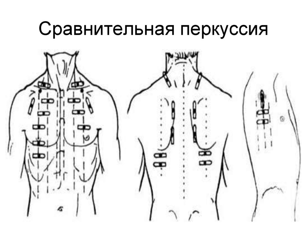 Сравнительная перкуссия