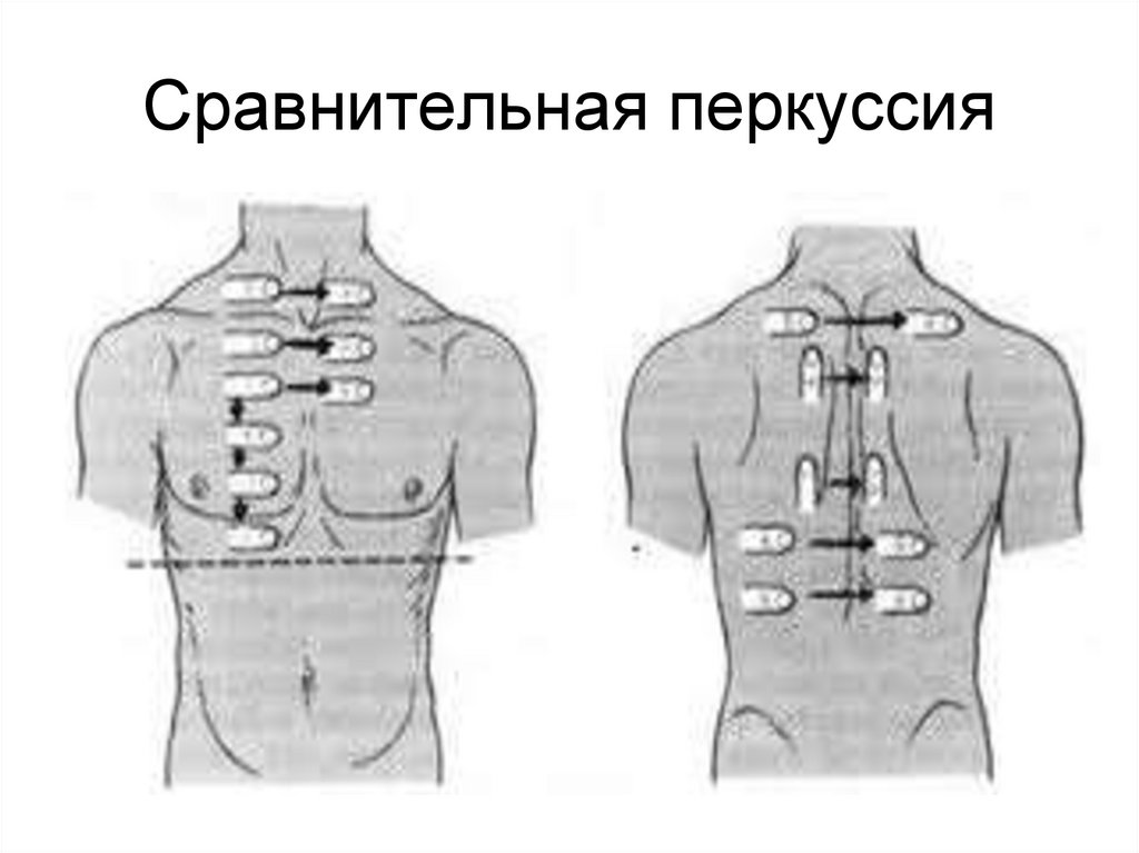 Сравнительная перкуссия