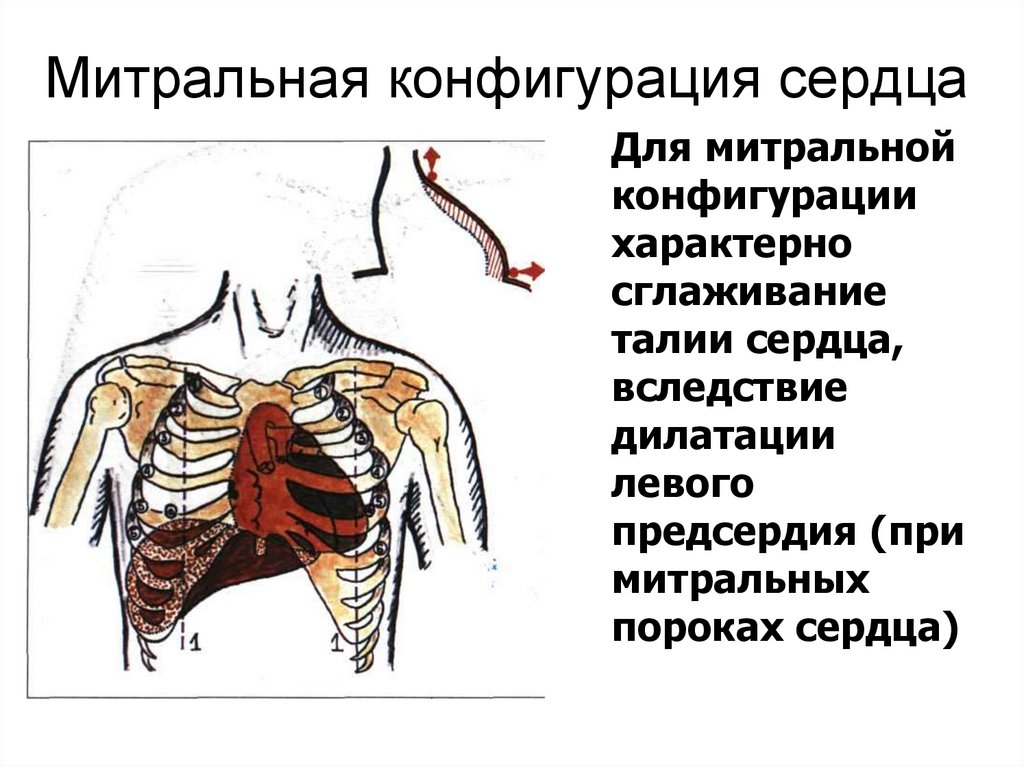 Митральная конфигурация сердца
