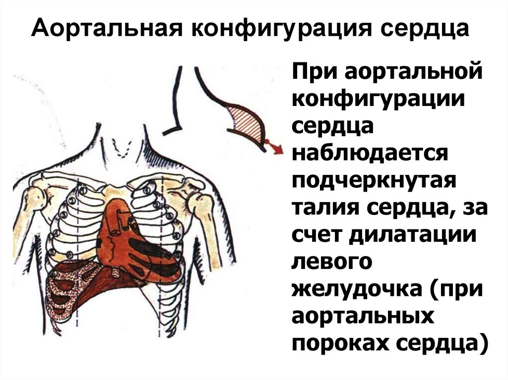 Аортальная конфигурация сердца