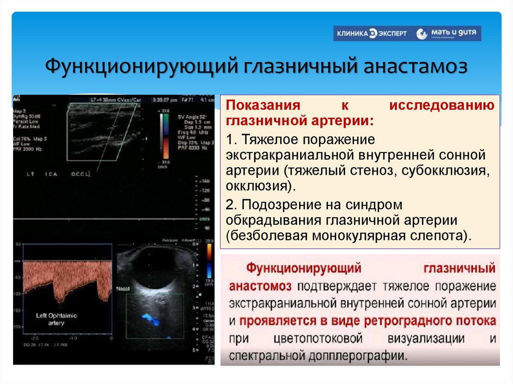 Функционирующий глазничный анастамоз