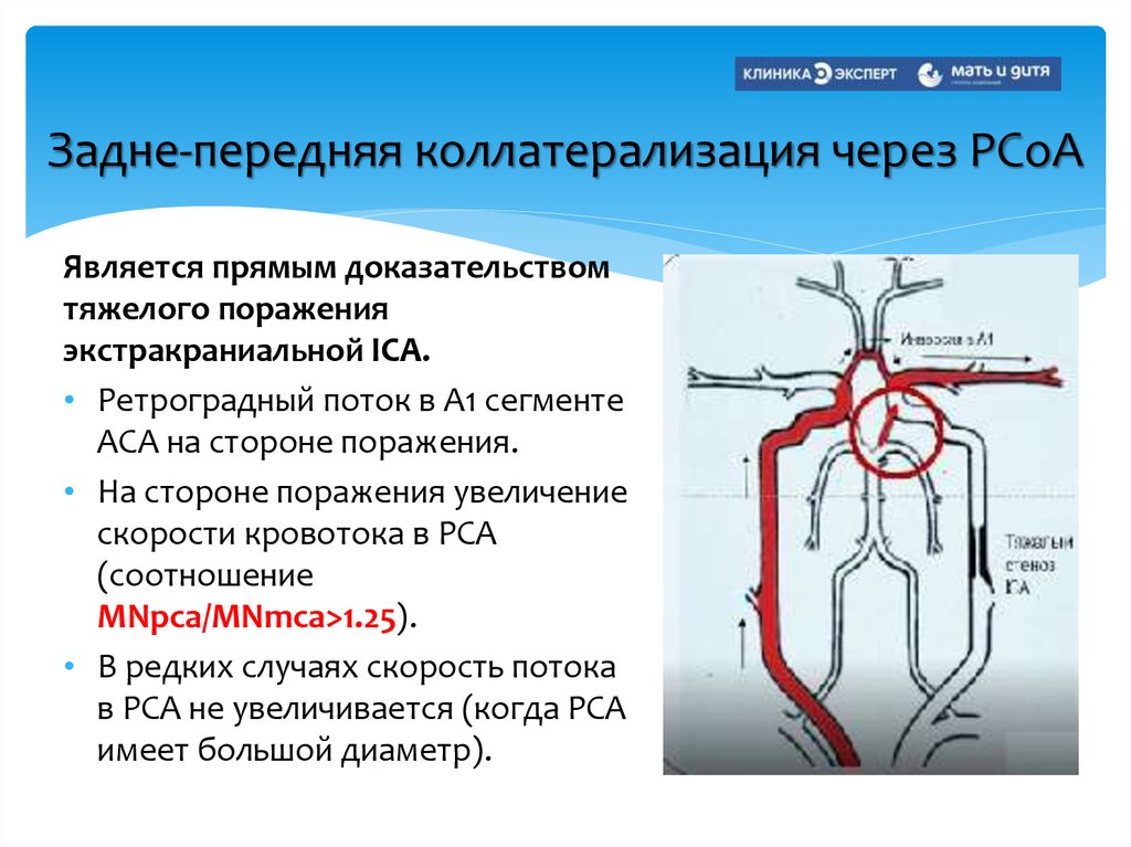 Задне-передняя коллатерализация через РСоА