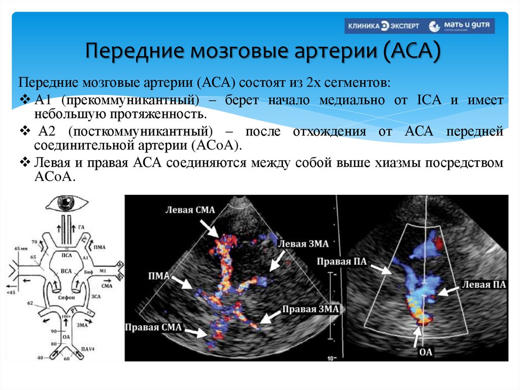 Передние мозговые артерии (АСА)