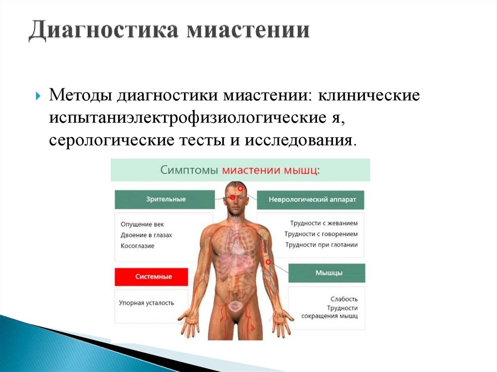 Диагностика миастении