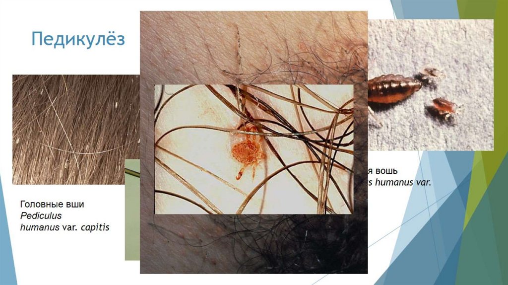 Педикулёз