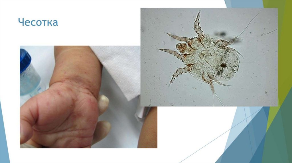 Чесотка