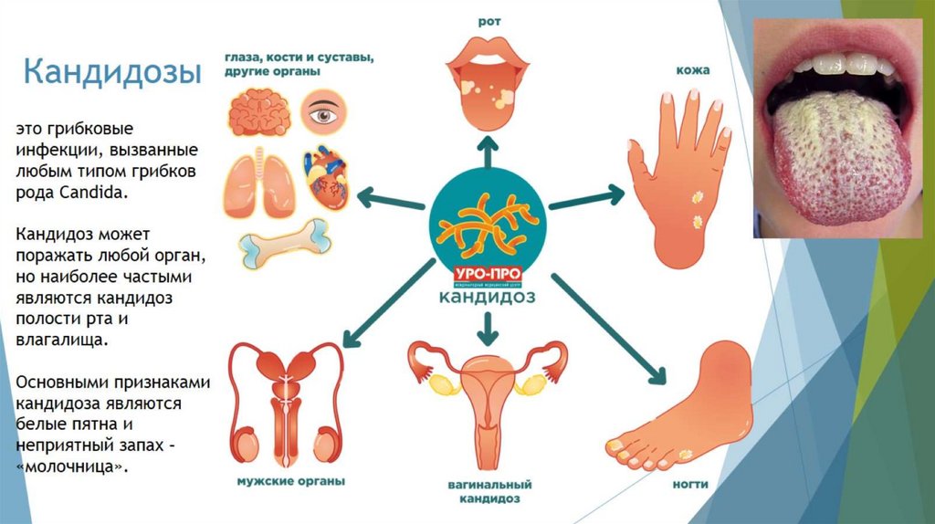 Кандидозы