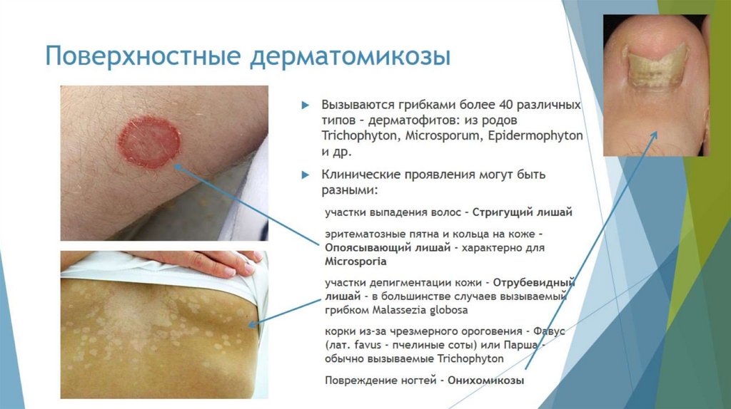 Поверхностные дерматомикозы