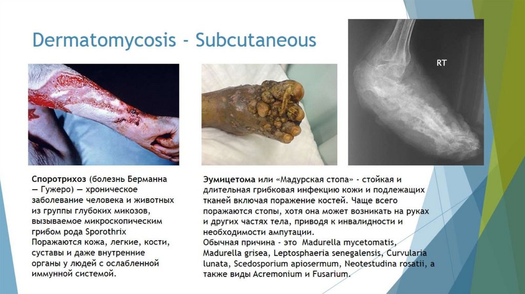 Dermatomycosis - Subcutaneous