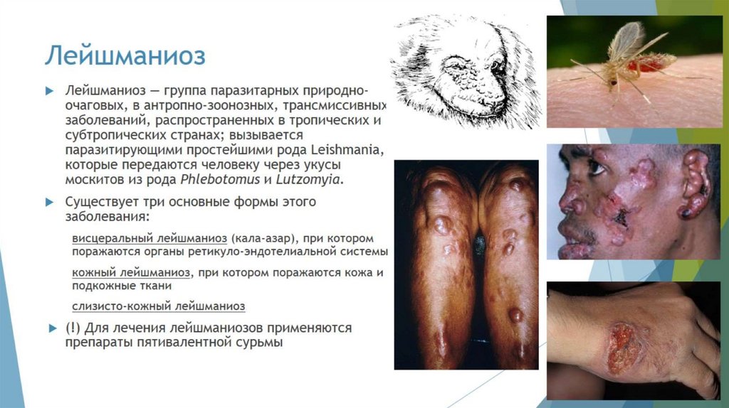 Лейшманиоз