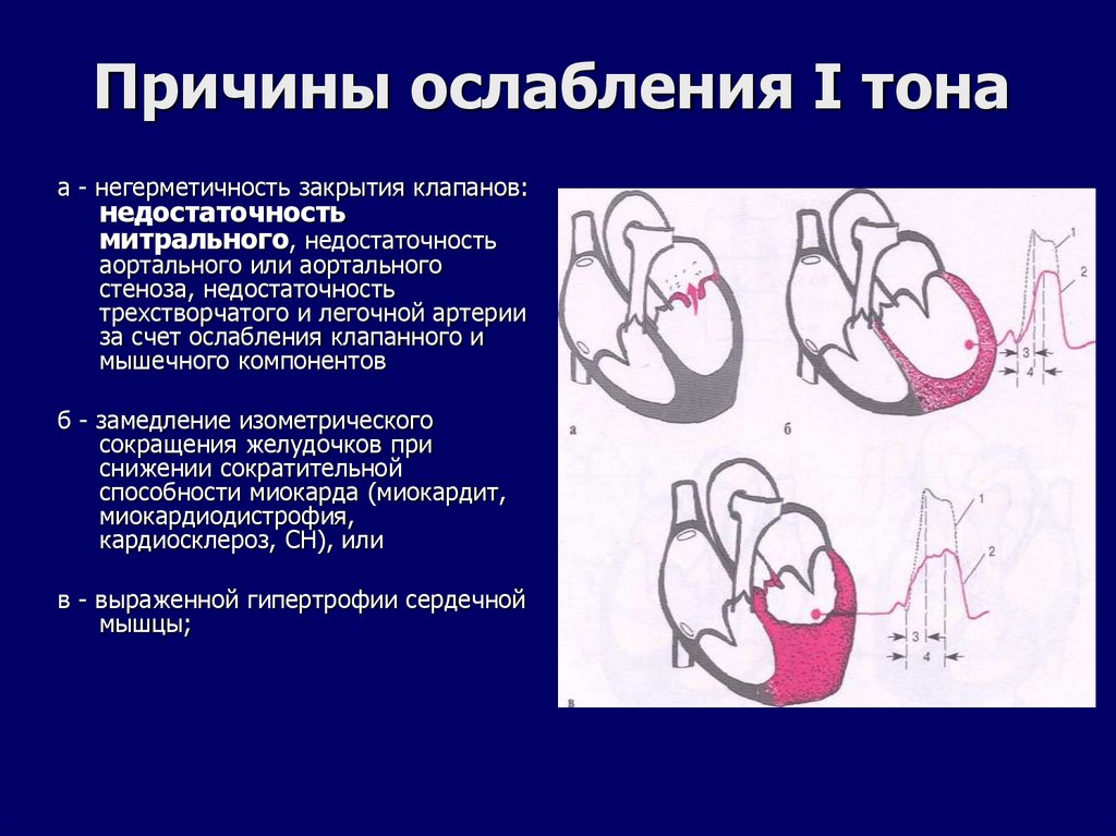 Причины ослабления I тона