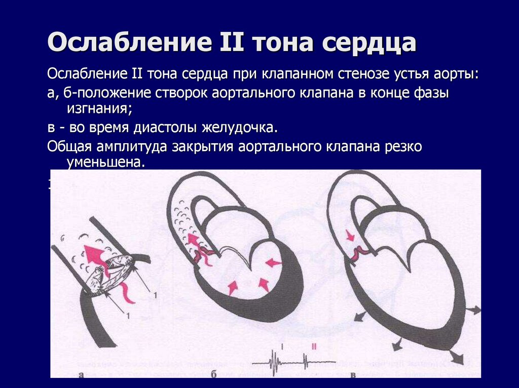 Ослабление II тона сердца