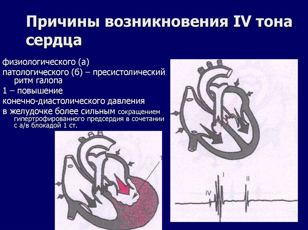 Причины возникновения IV тона сердца