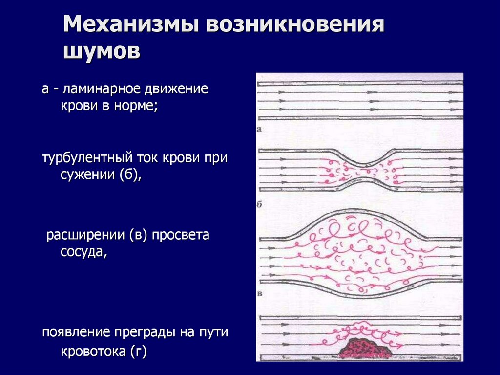 Механизмы возникновения шумов