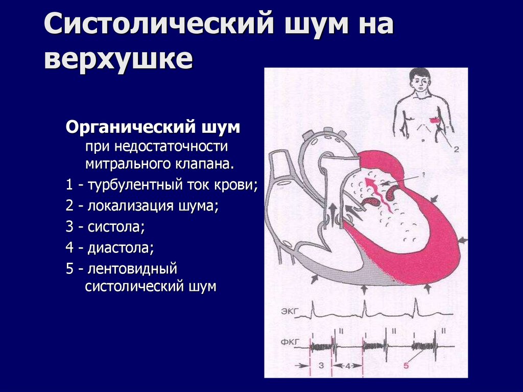 Систолический шум на верхушке