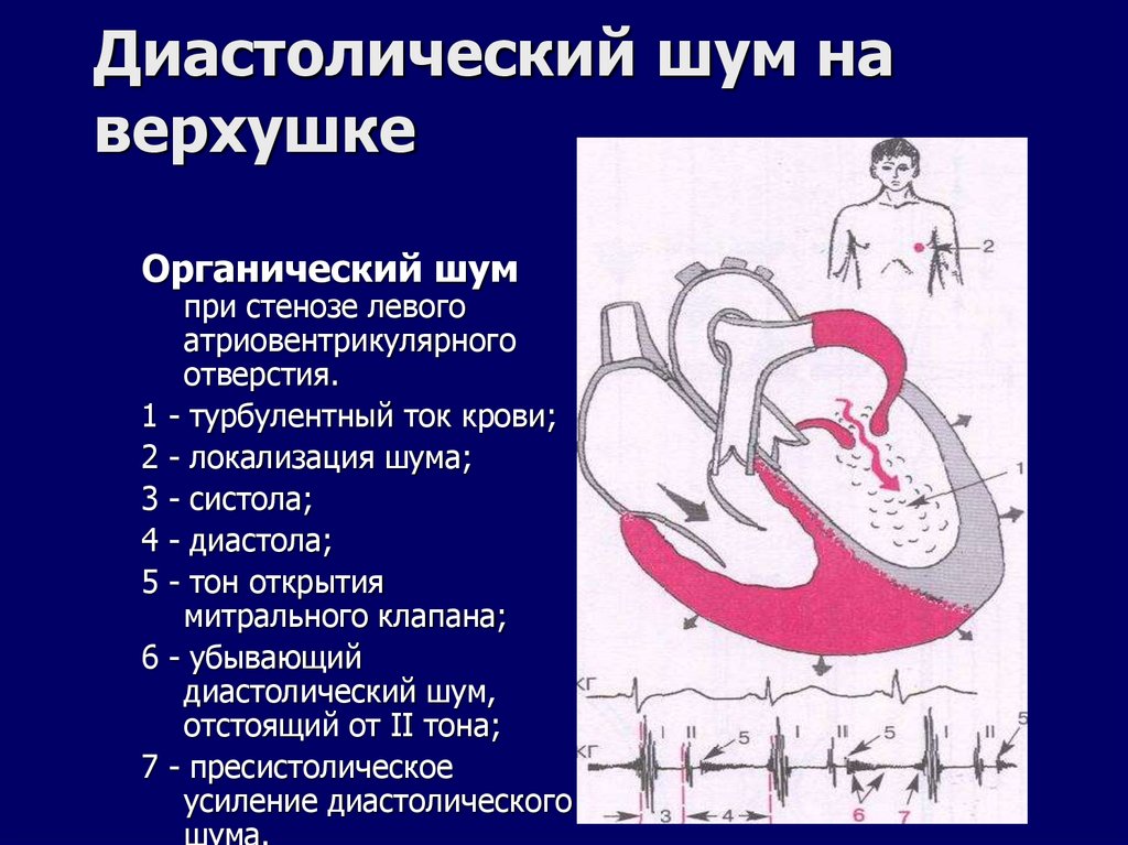 Диастолический шум на верхушке