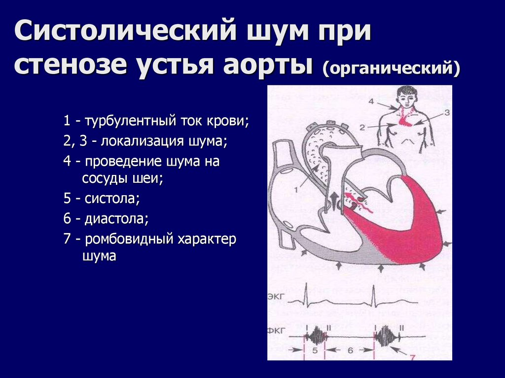 Систолический шум при стенозе устья аорты (органический)