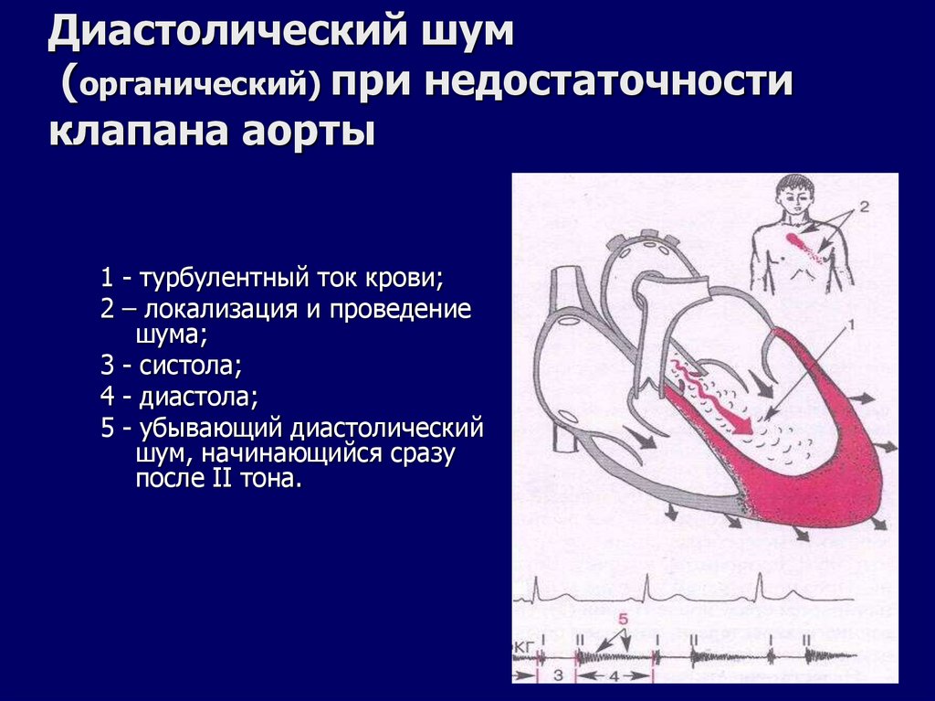 Диастолический шум (органический) при недостаточности клапана аорты