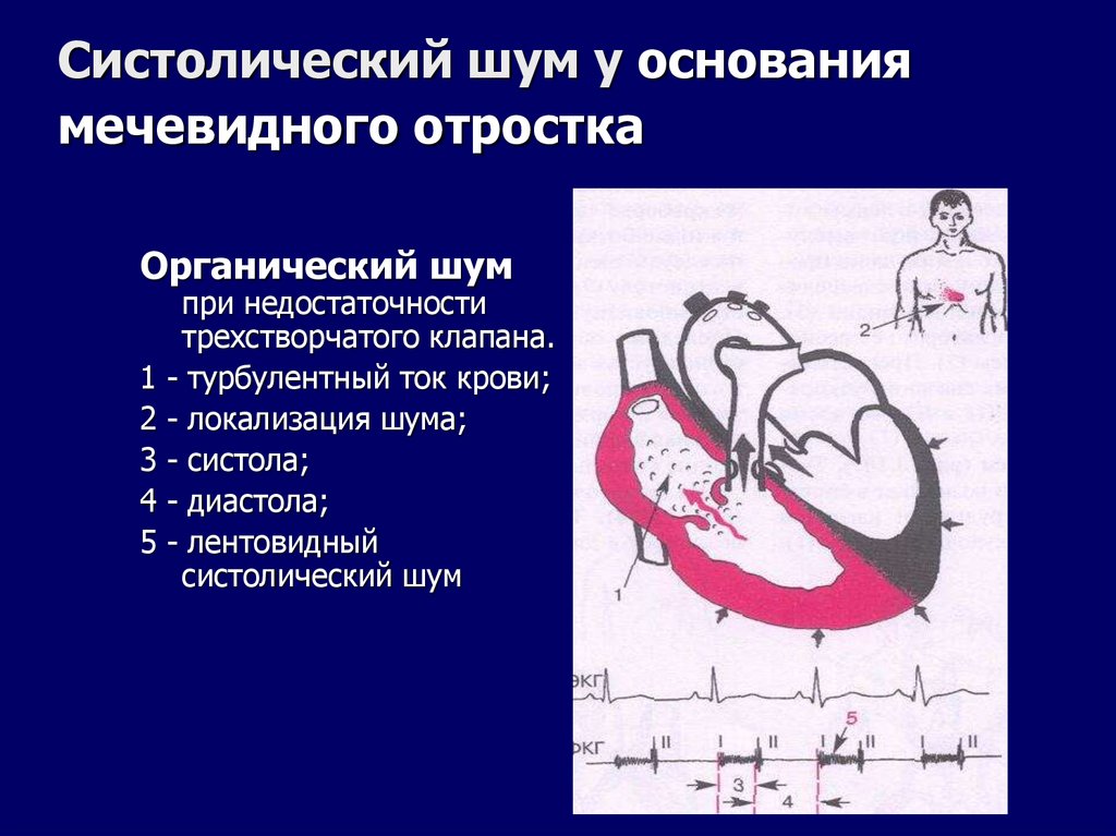 Систолический шум у основания мечевидного отростка