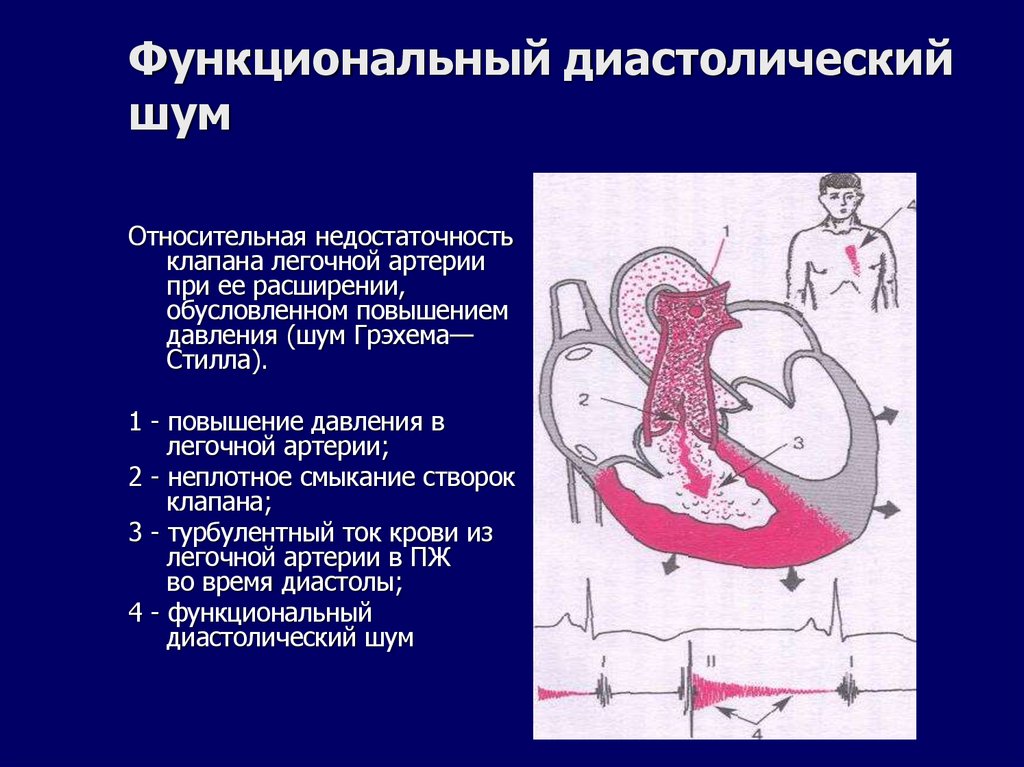 Функциональный диастолический шум