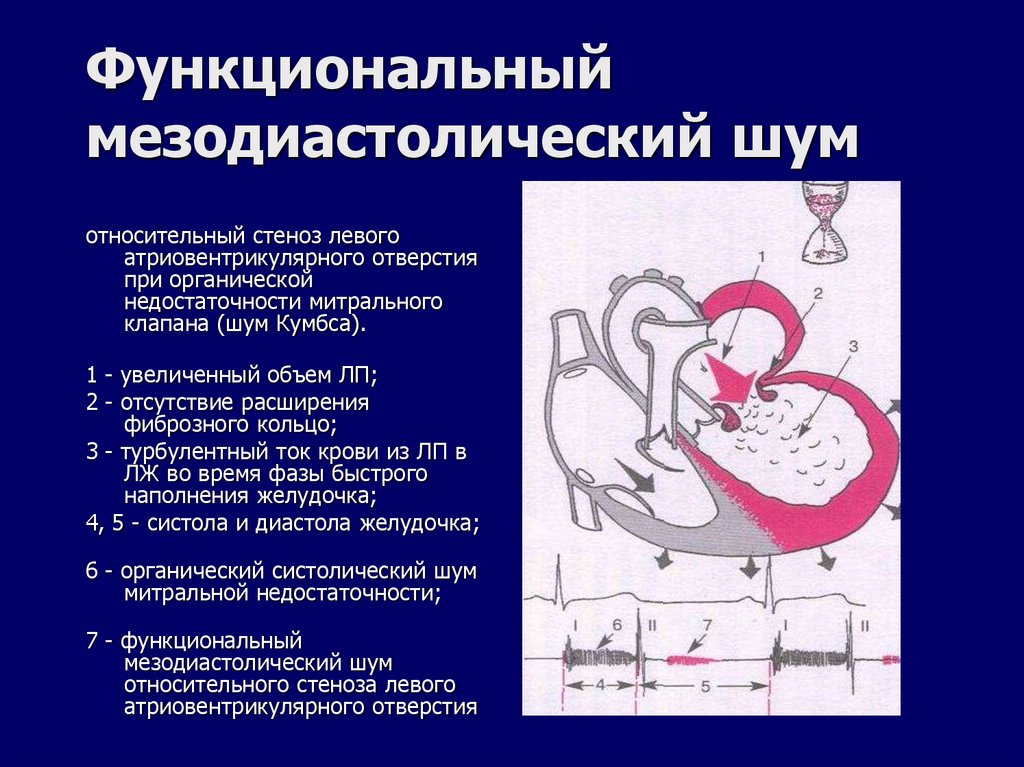 Функциональный мезодиастолический шум