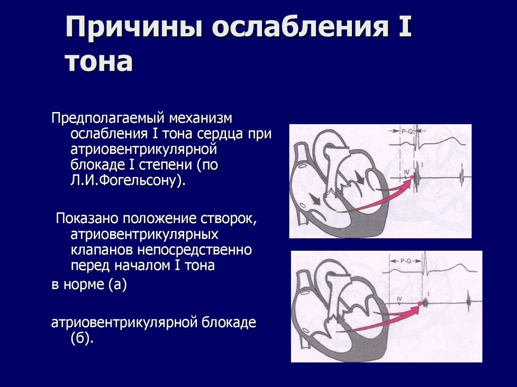 Причины ослабления I тона
