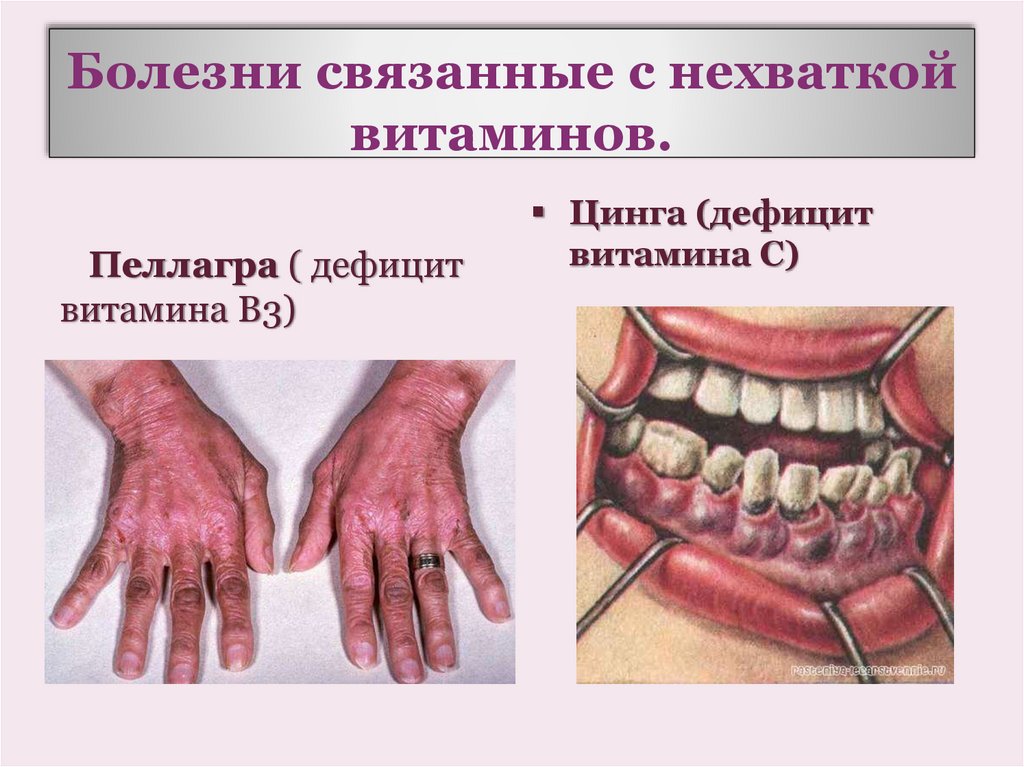 Болезни связанные с нехваткой витаминов.