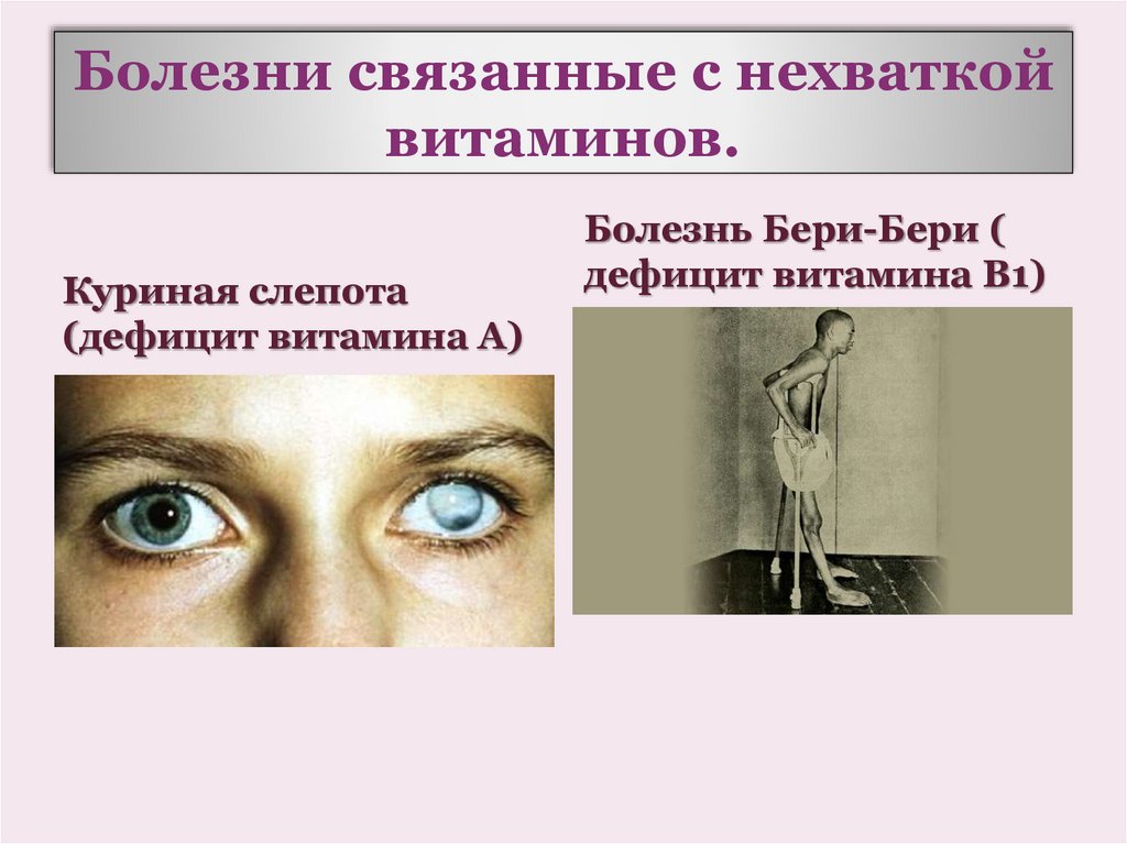 Болезни связанные с нехваткой витаминов.