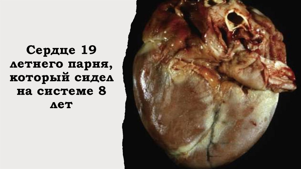 Сердце 19 летнего парня, который сидел на системе 8 лет