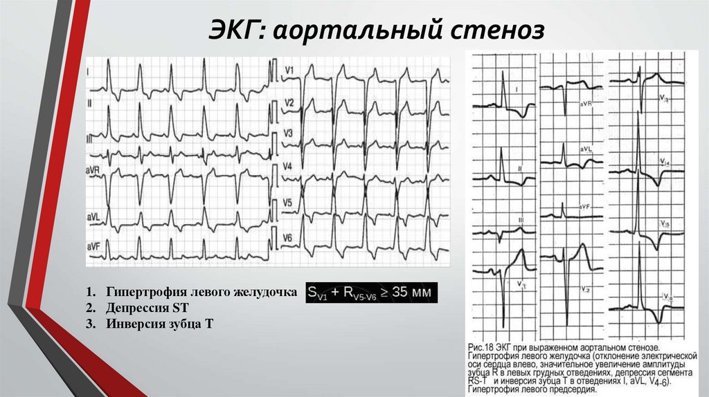 ЭКГ: аортальный стеноз