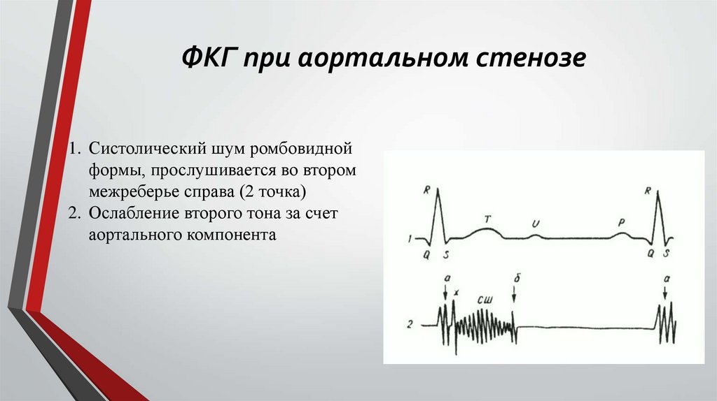 ФКГ при аортальном стенозе