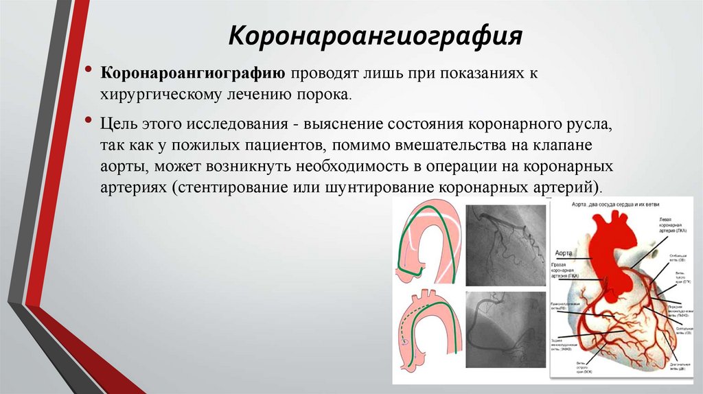 Коронароангиография