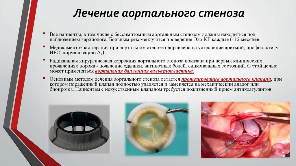 Лечение аортального стеноза