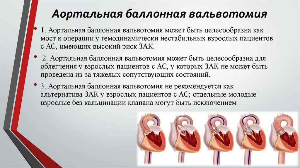 Аортальная баллонная вальвотомия