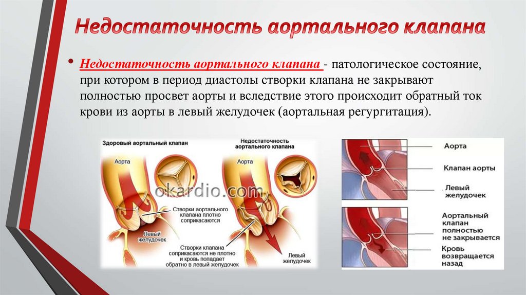 Недостаточность аортального клапана