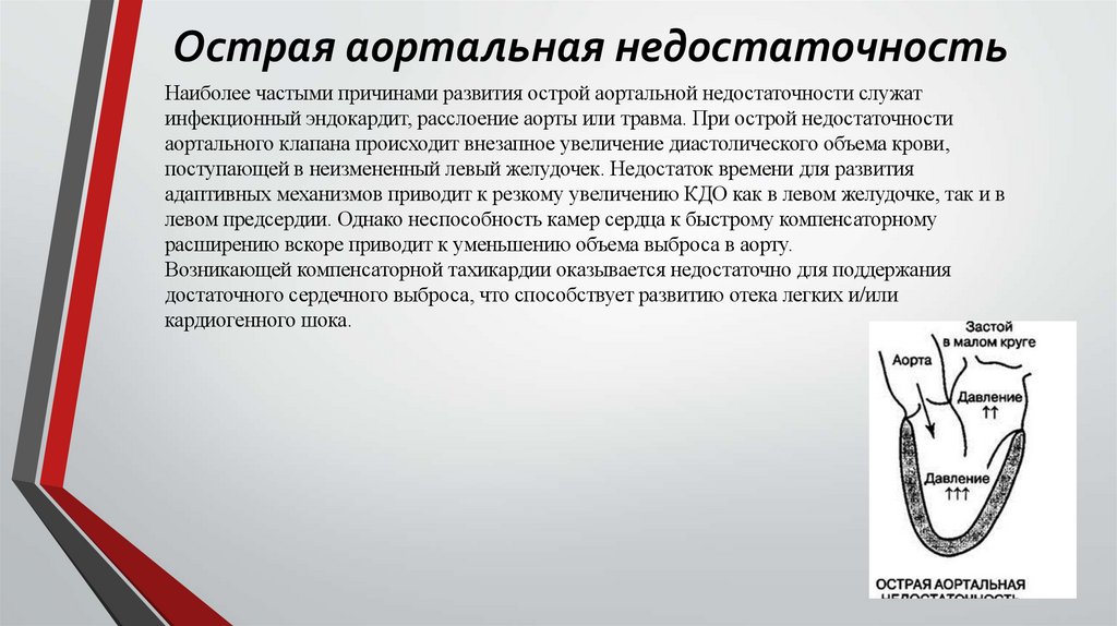 Острая аортальная недостаточность