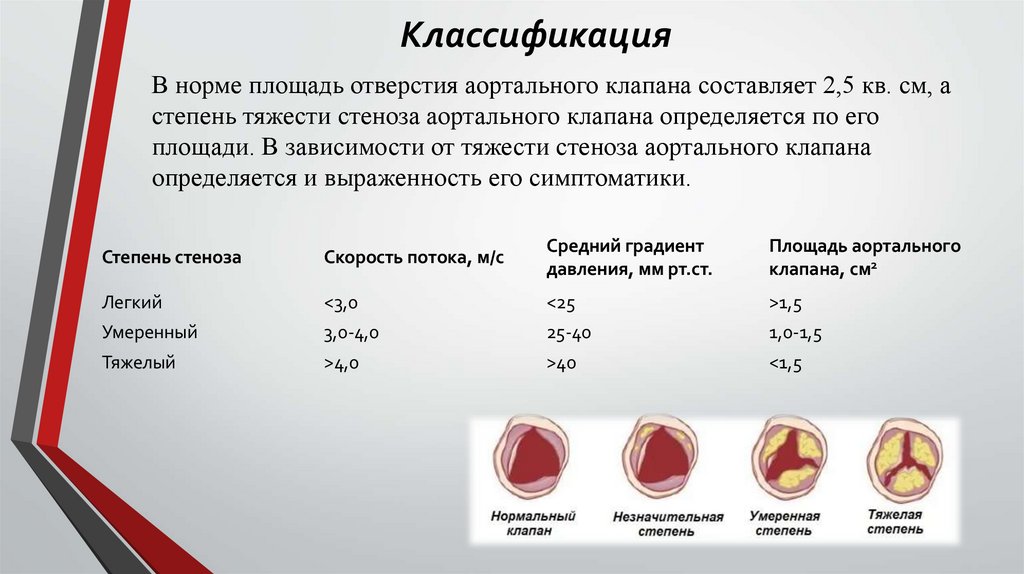 В норме площадь отверстия аортального клапана составляет 2,5 кв. см, а степень тяжести стеноза аортального клапана определяется