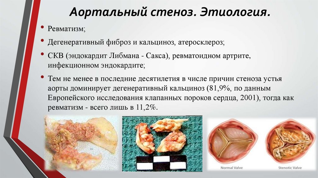 Аортальный стеноз. Этиология.