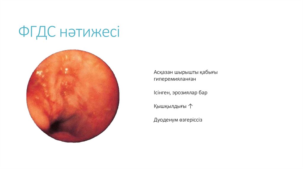 ФГДС нәтижесі