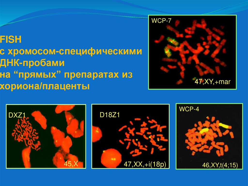 FISH с хромосом-специфическими ДНК-пробами на “прямых” препаратах из хориона/плаценты