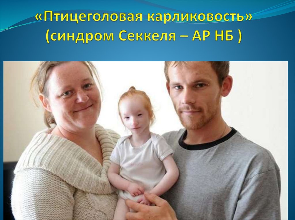 «Птицеголовая карликовость» (синдром Секкеля – АР НБ )