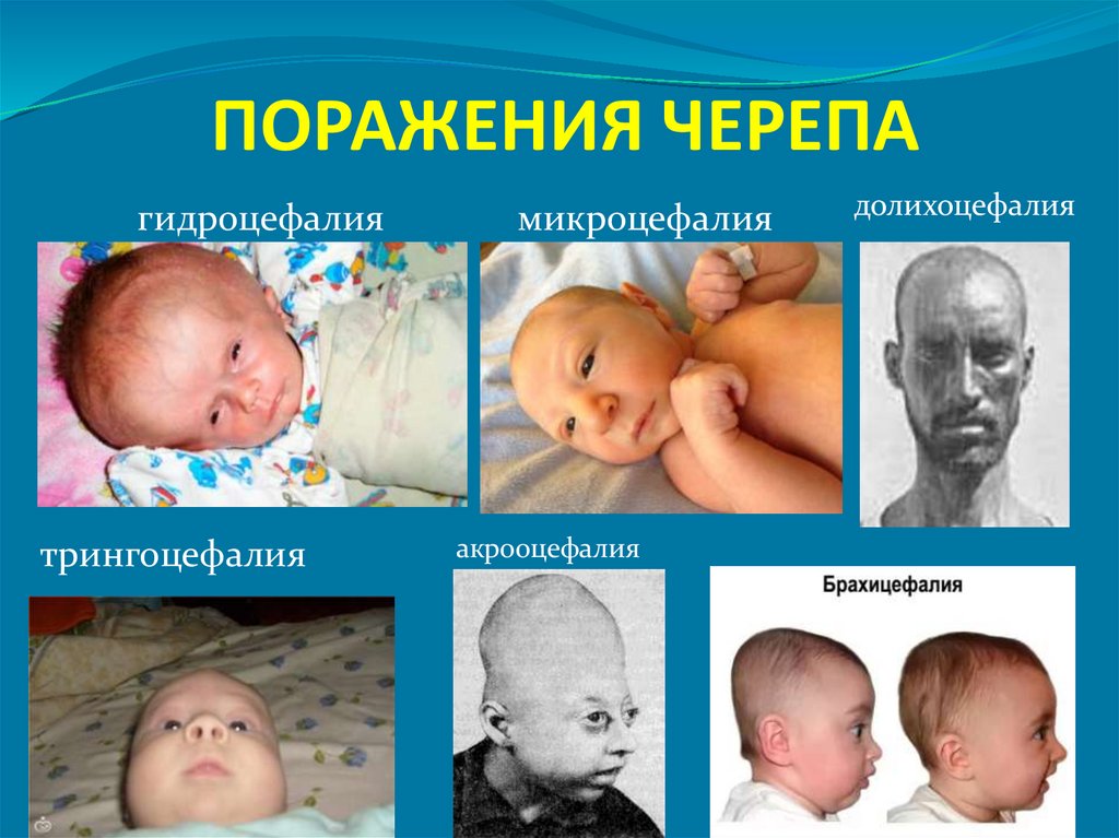 ПОРАЖЕНИЯ ЧЕРЕПА