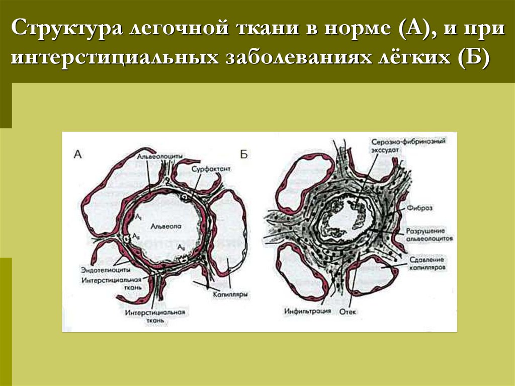 Структура легочной ткани в норме (А), и при интерстициальных заболеваниях лёгких (Б)