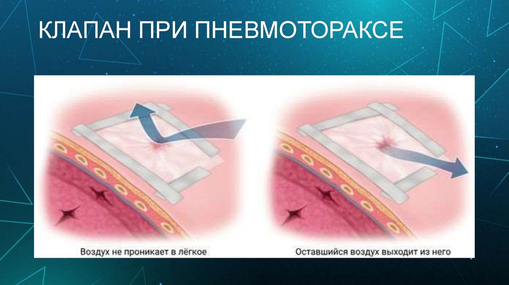 КЛАПАН ПРИ ПНЕВМОТОРАКСЕ