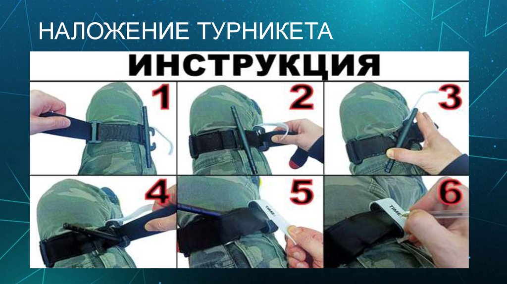 НАЛОЖЕНИЕ ТУРНИКЕТА